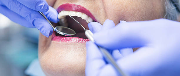 Best Emergency Dentist for Lost Fillings or Crowns in Milpitas, CA