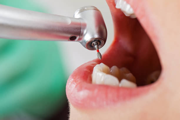 Best Broken or Cracked Tooth Emergency Dentist in Milpitas, CA